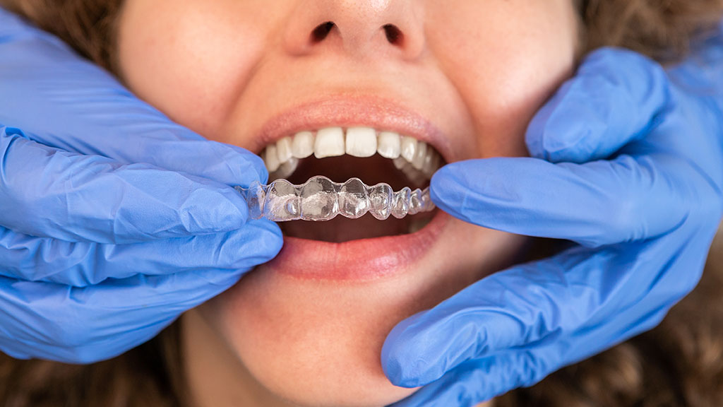 Adults Choosing Invisalign